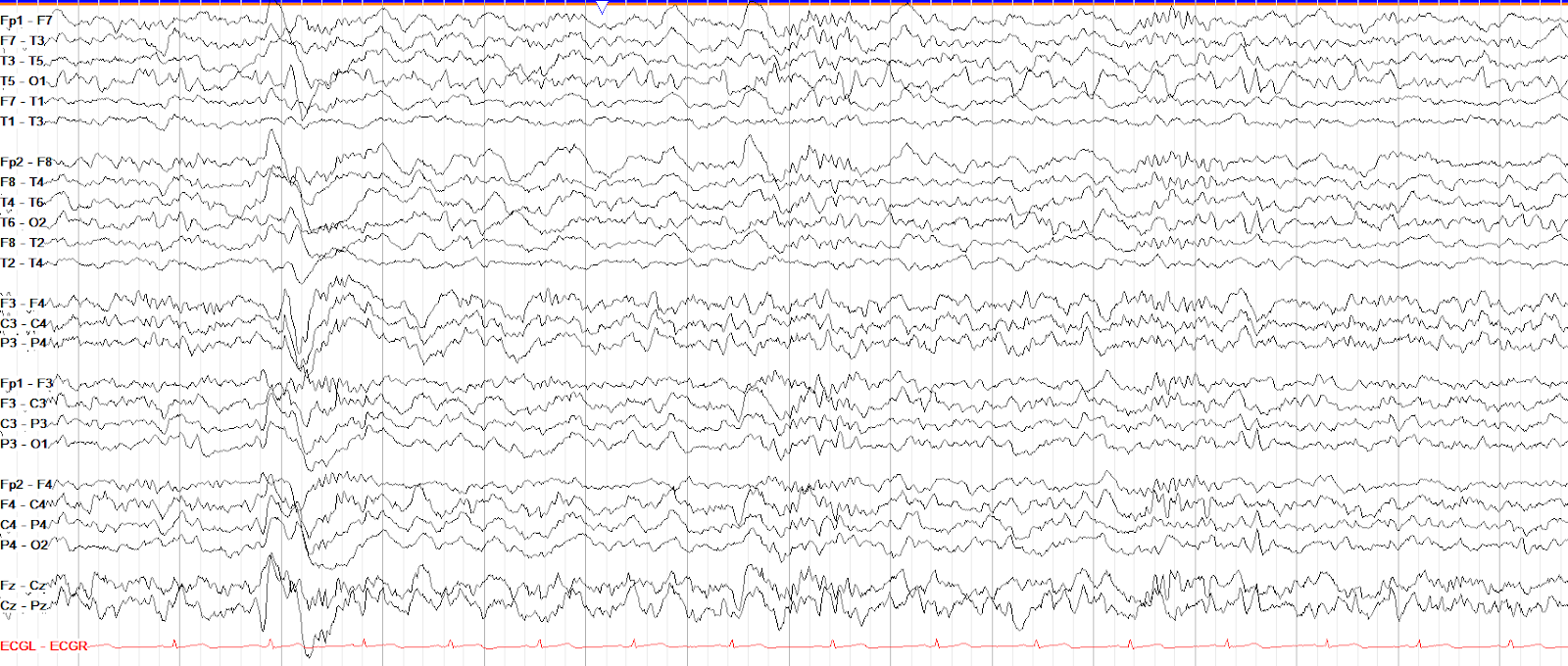Early slow wave sleep